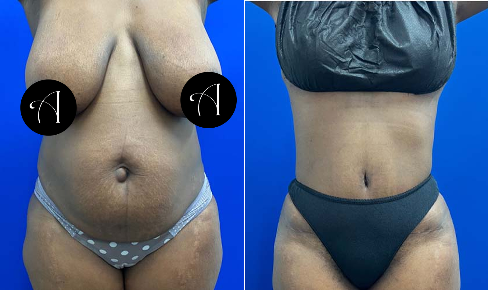 BxA10-Tummy-Tuck.png