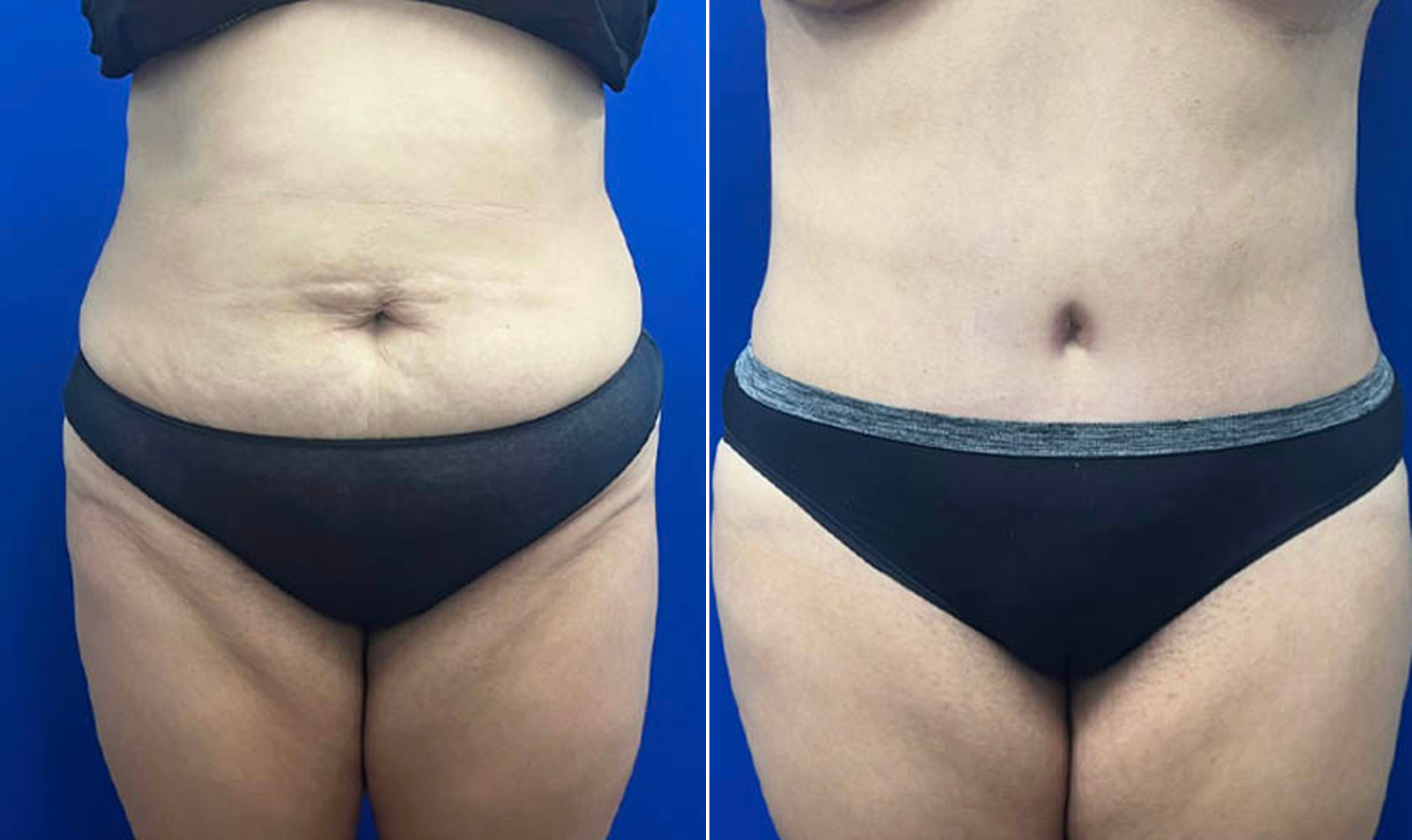 BxA5-Tummy-Tuck.png